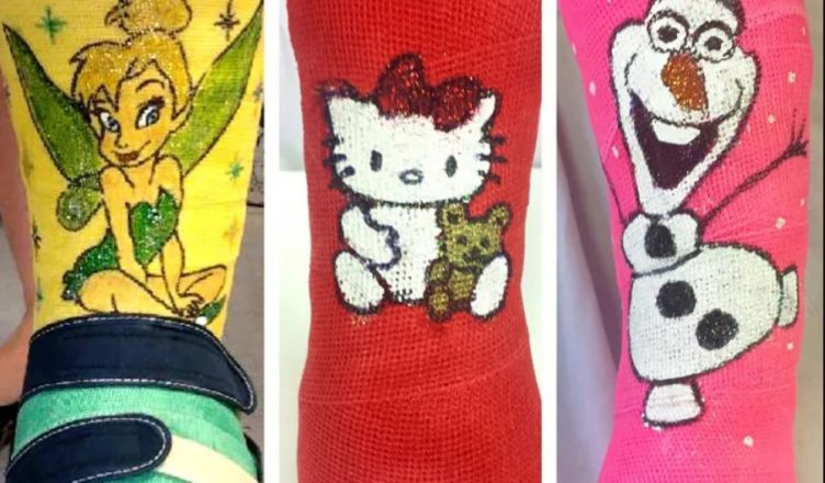 California Hospital Tech Brightens Kids’ Casts with Amazing Artwork. See why they do this.
